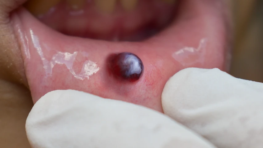 Blood blister inside the mouth